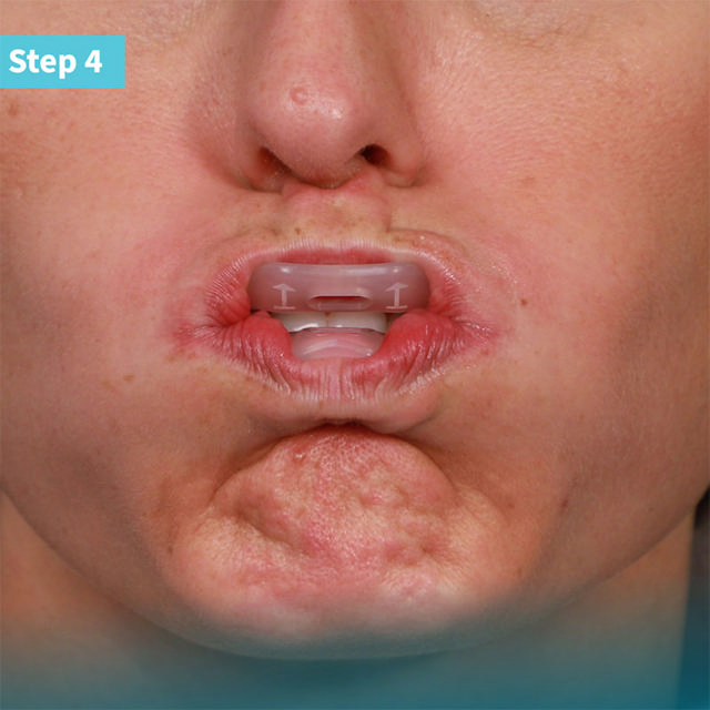 Umbrella læbe-og kindholder medium 20stk